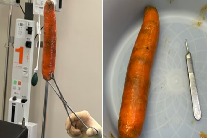 Homem vai parar na emergência com “cenourão” enfiado no ânus homem-vai-parar-na-emergencia-com-“cenourao”-enfiado-no-anus