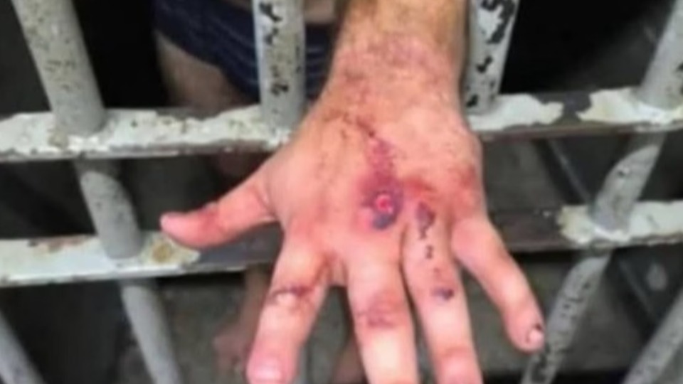 Veja como ficou a mão de ex-jogador após agredir mulher com 61 socos veja-como-ficou-a-mao-de-ex-jogador-apos-agredir-mulher-com-61-socos