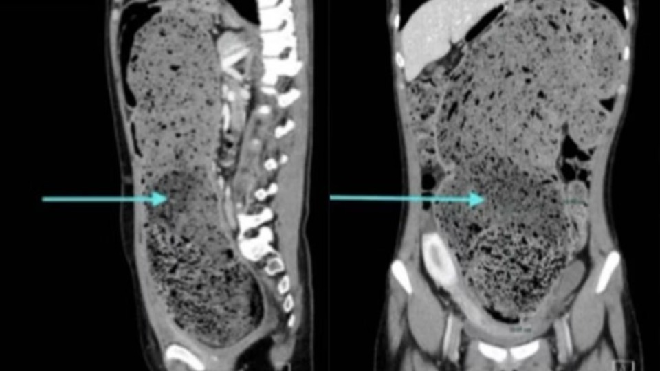 Mulher passa quatro meses constipada e perde 4,5 kg após tratamento mulher-passa-quatro-meses-constipada-e-perde-4,5-kg-apos-tratamento