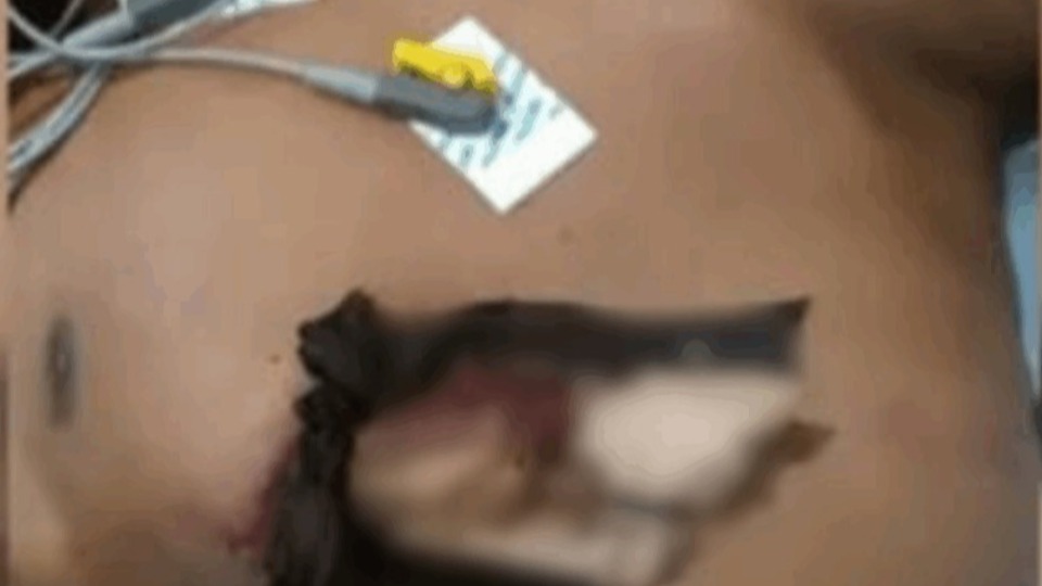 Jovem tem tórax perfurado por pedaço de madeira durante corte de árvore jovem-tem-torax-perfurado-por-pedaco-de-madeira-durante-corte-de-arvore