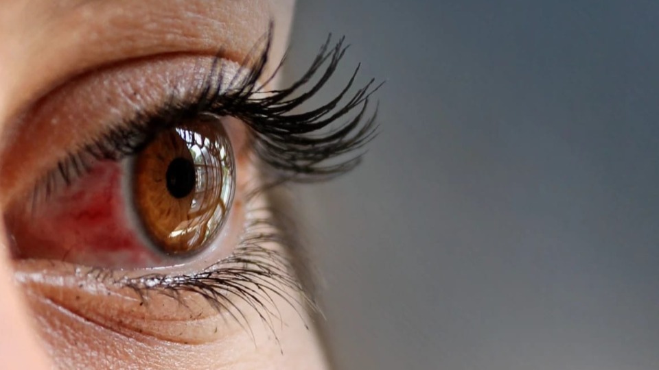 AVC nos olhos pode levar à perda total da visão, alertam médicos avc-nos-olhos-pode-levar-a-perda-total-da-visao,-alertam-medicos