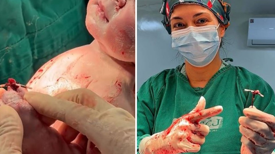 Bebê nasce com DIU na mão após falha do método contraceptivo bebe-nasce-com-diu-na-mao-apos-falha-do-metodo-contraceptivo