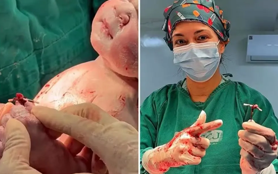 Bebê nasce em Goiás segurando DIU após gravidez inesperada da mãe bebe-nasce-em-goias-segurando-diu-apos-gravidez-inesperada-da-mae