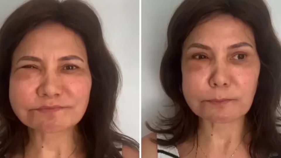 Médica tem reação alérgica a ácido hialurônico após mais de um ano de preenchimento medica-tem-reacao-alergica-a-acido-hialuronico-apos-mais-de-um-ano-de-preenchimento