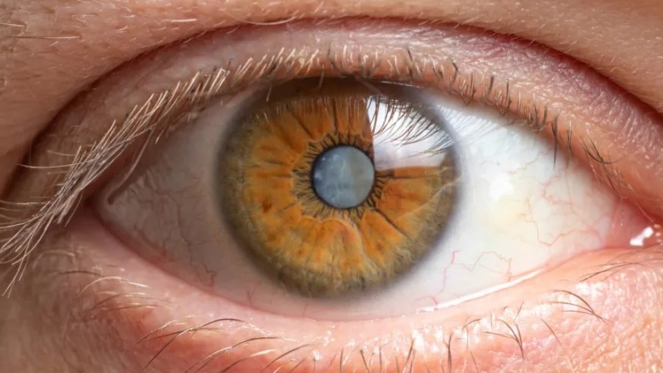 Cirurgia de catarata melhora sono e saúde, diz pesquisa cirurgia-de-catarata-melhora-sono-e-saude,-diz-pesquisa